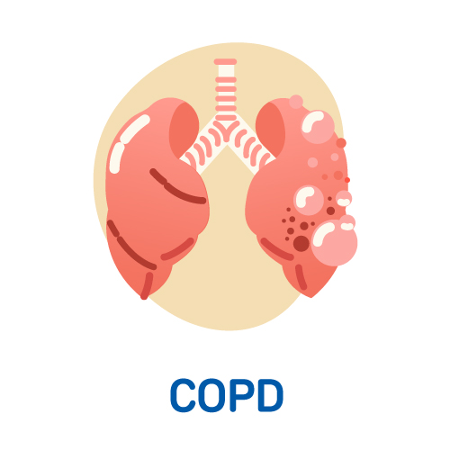 COPD