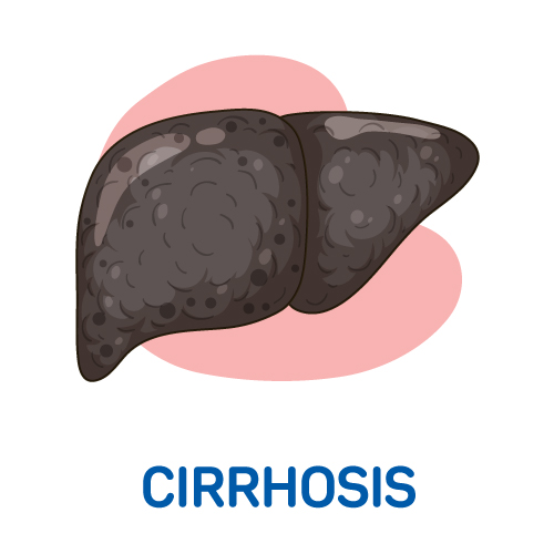 Cirrhosis