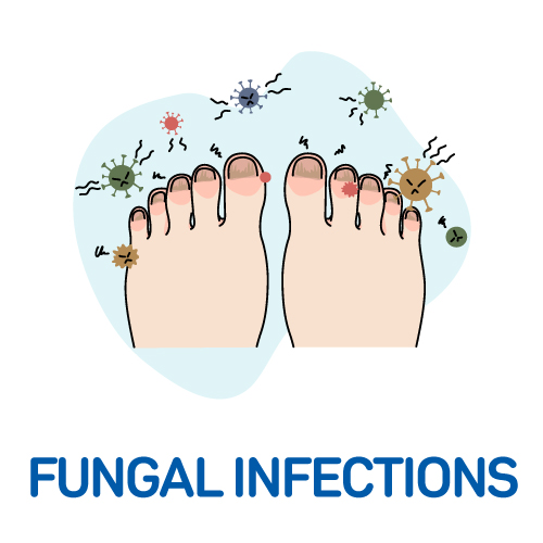 Fungal Infections