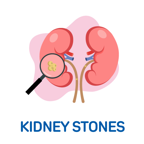 Kidney Stones