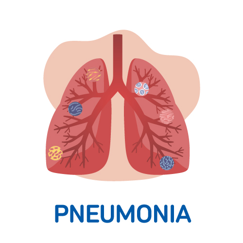 Pneumonia