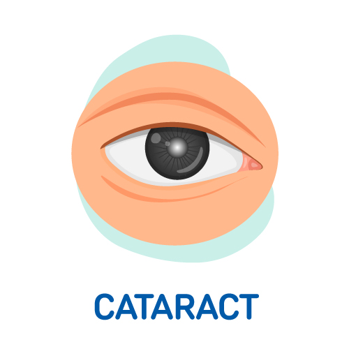 Cataract