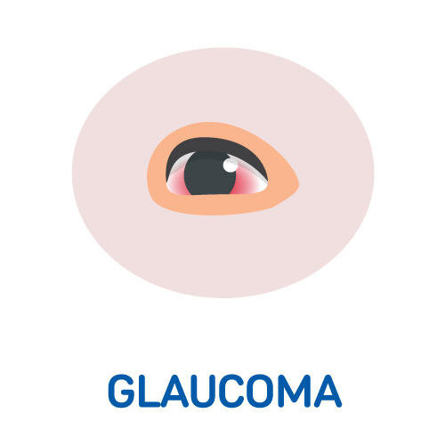 Glaucoma