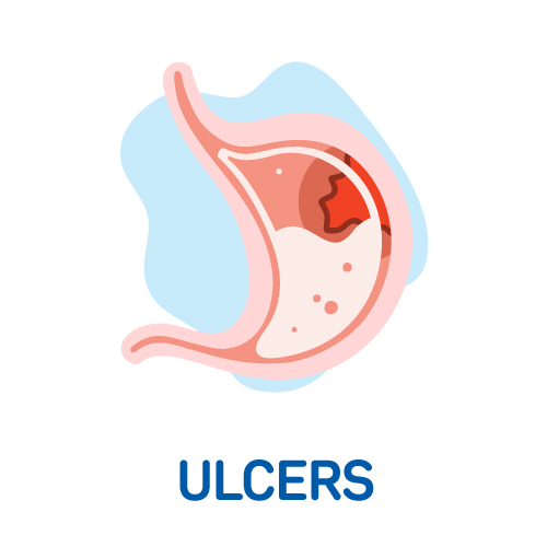 Ulcers